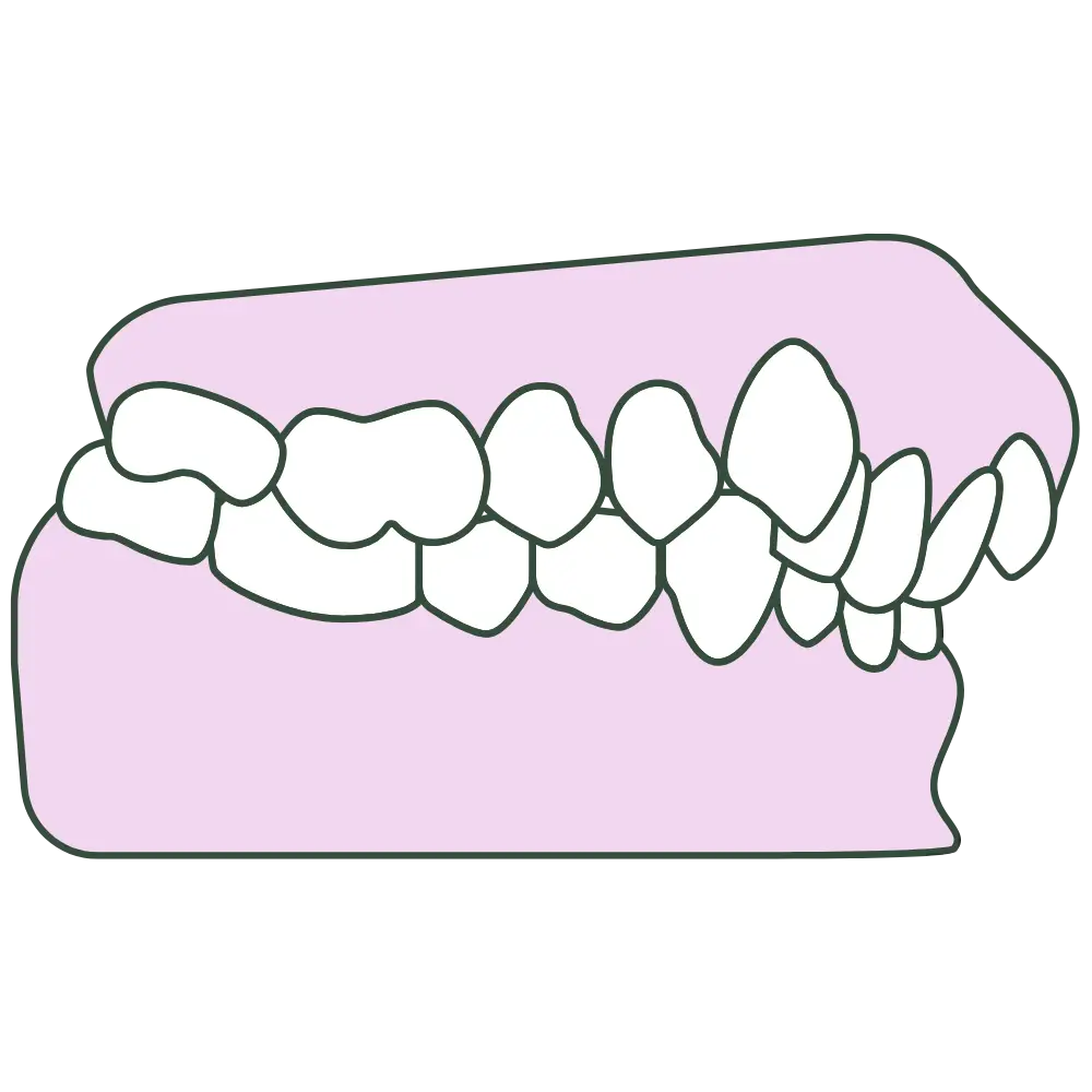crowding jaw profile