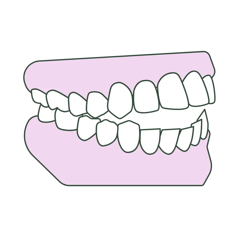 open bite profile from tongue thrusting