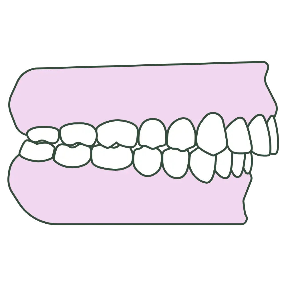 overbite jaw profile