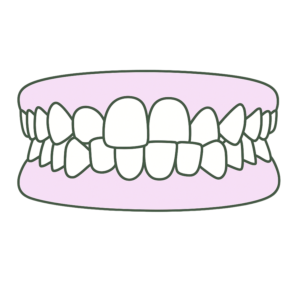 front view of an anterior crossbite