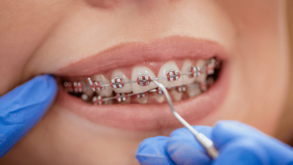 Braces orthodontic adjustment Oakton, VA